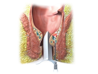 LHP® - LaserHemorrhoidoPlasty